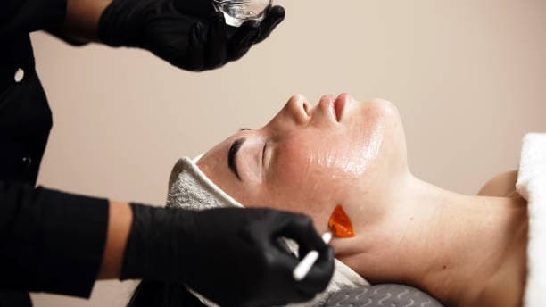 Peeling Químico